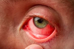 Konon katanya mata manusia bisa berubah jadi pink? Inilah pink eye yang salah satu penyebabnya adalah Covid-19