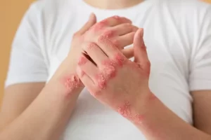 Pemicu dan gejala psoriasis peradangan kulit disertai gatal dan panas, tips cegah kambuh dari dr. Henry Tanojo