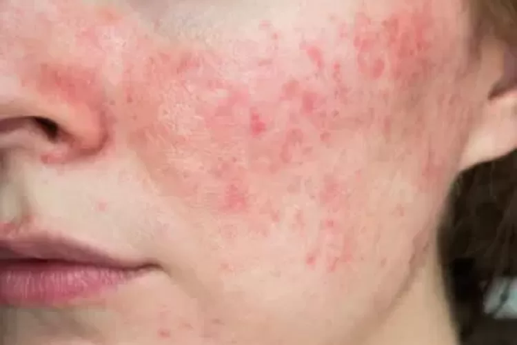 Wajah terlihat dan berbintik merah seperti iritasi? Kenali rosacea papulopustular dan apa yang perlu diketahui