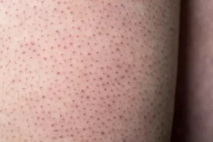 Mengenal Keratosis Pilaris atau penyakit yang sering disebut kulit ayam, apa penyebab dan pengobatannya