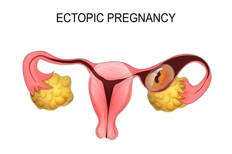 Mengenal ectopic pregnancy, kondisi hamil di luar kandungan