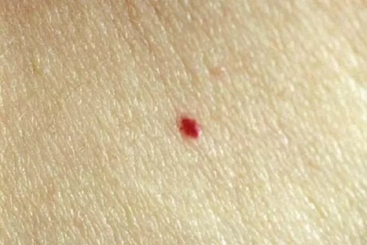 Muncul bintik merah pada kulit? Kenali cherry angioma yang terlihat seperti tahi lalat berwarna merah