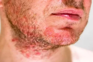 Kulit kepala berketombe dan iritasi? Yuk kenali gejala dermatitis seboroik yang juga bisa muncul pada bayi