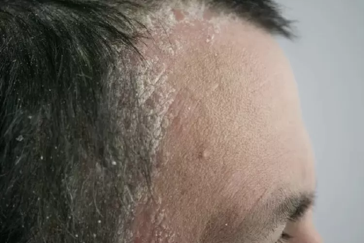 Mirip ketombe, ini dia penjelasan ilmiah  scalp psoriasis yang bisa sebabkan kulit kepala bersisik putih