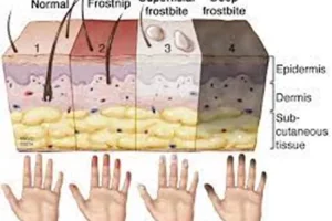 Waspada anak gunung! Frostbite, cedera karena pembekuan kulit dengan suhu di bawah 0 derajat celcius