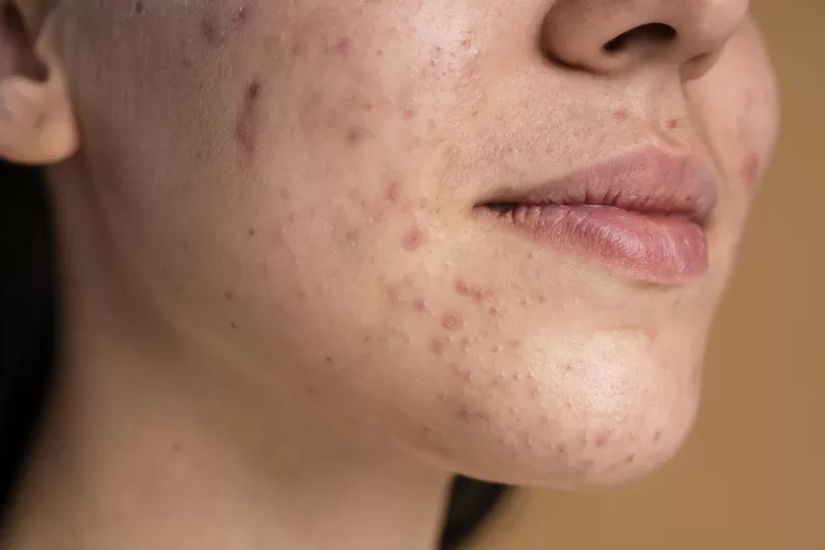 Timbul jerawat di dagu? Ini penjelasan dermatologis soal penyebab dan tips menghilangkannya!