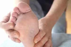 Waspada 6 penyebab kulit kaki mengelupas menurut para ahli dermatologi, nomor 1 paling sering terjadi