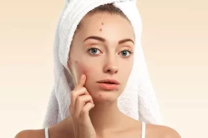 Rekomendasi makeup untuk kulit berjerawat dan berminyak agar terlihat mulus